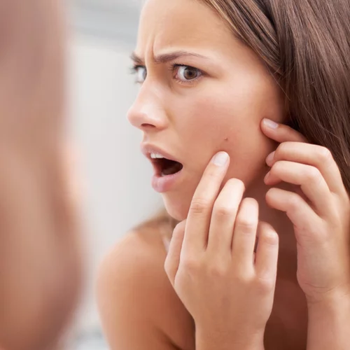 Βρήκαμε τι να κάνεις για να μην ξαναμπείς στον πειρασμό να σπάσεις τα σπυράκια σου