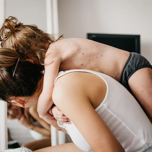 Ευλογιά των πιθήκων ή ανεμοβλογιά: Πώς θα τα ξεχωρίσουμε