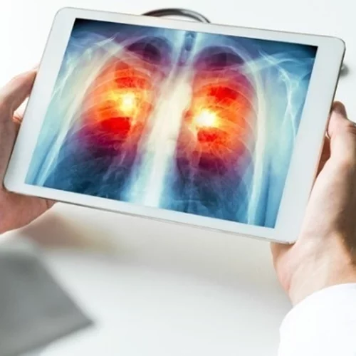 Έρευνα εντοπίζει άγνωστο μοριακό μονοπάτι για την αναχαίτιση του καρκίνου του πνεύμονα