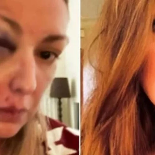 Σοκάρει γνωστή Ελληνίδα food blogger, η οποία έπεσε θύμα κακοποίησης | Οι φωτογραφίες μετά τον ξυλοδαρμό