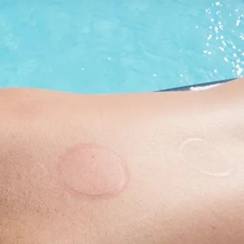 Ολυμπιακοί αγώνες 2024 | Οι βεντούζες τελικά μειώνουν τον πόνο;