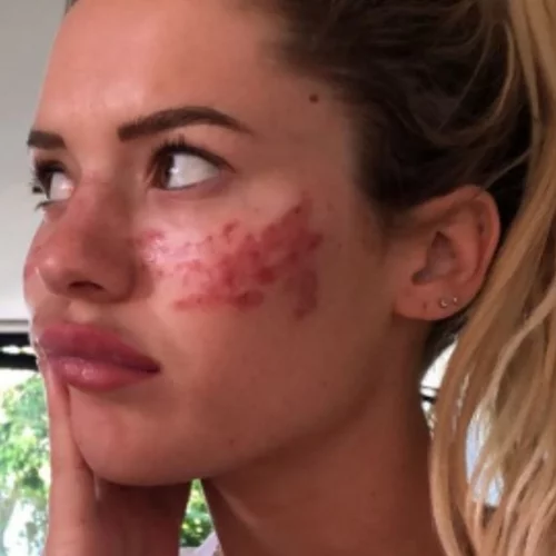 "Μην το δοκιμάσετε στο σπίτι" | Σταρ της τηλεόρασης βρέθηκε στο νοσοκομείο από βίντεο ομορφιάς του Tik Tok