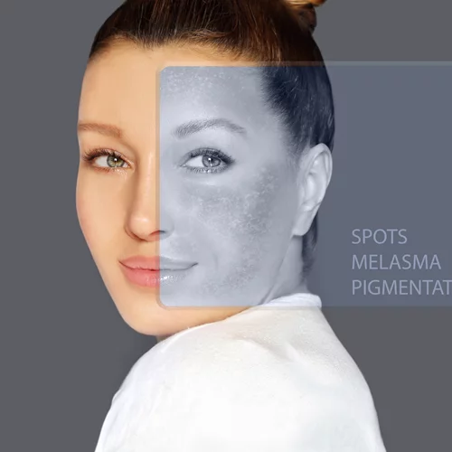 Ποιος φοβάται τις κηλίδες; Όχι εγώ!