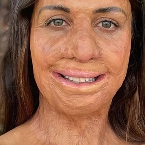 "Το 65% του σώματός μου είχε καεί αλλά επέζησα". Μια τραγική ιστορία επιβίωσης