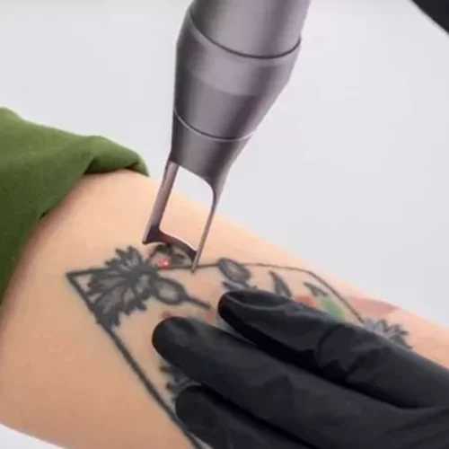 Όλα όσα πρέπει να γνωρίζεις προτού αφαιρέσεις ένα τατουάζ
