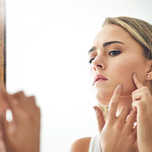 5 μύθοι για την ακμή που ο δερματολόγος σου θα ήθελε να σταματήσεις να πιστεύεις