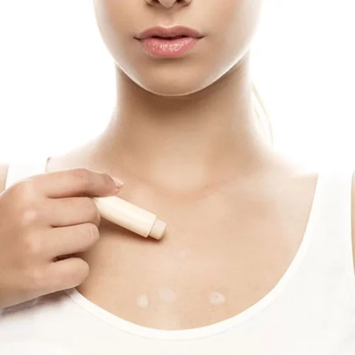 Πώς να καλύψω τα σπυράκια στο σώμα το καλοκαίρι!