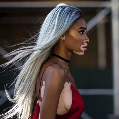 Winnie Harlow: Το μοντέλο που πάσχει από λεύκη γίνεται viral μέσα από μία συγκινητική ανάρτηση