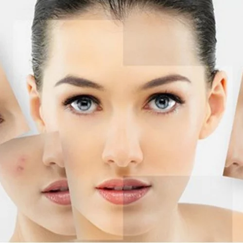 Έχεις λιπαρό-μεικτό δέρμα με τάση ακμής; Αυτή είναι η απόλυτη λύση για εσένα