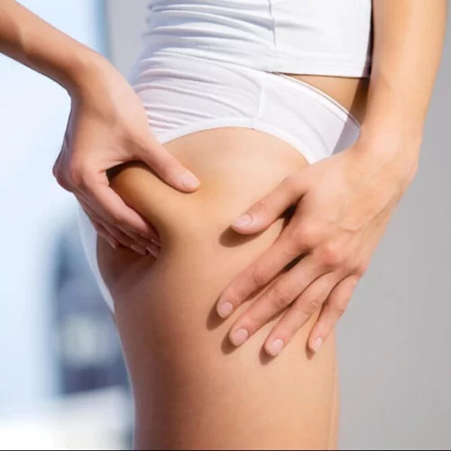 Οι δύο βασικοί λόγοι που έχεις κυτταρίτιδα και πώς θα την μειώσεις