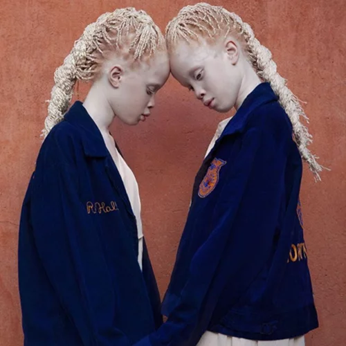 Γιατί είναι διάσημα αυτά τα δίδυμα με αλμπινισμό;