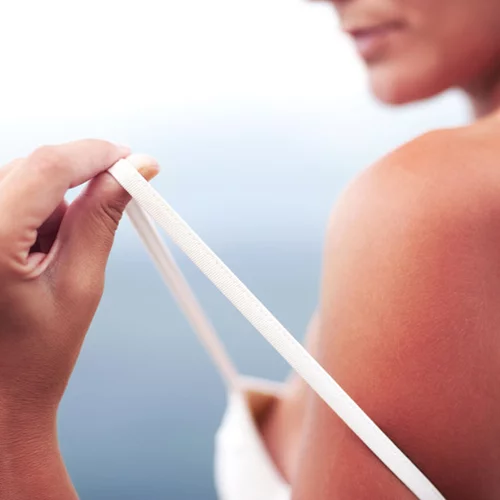 Πώς θα περιποιηθείς τα εγκαύματα του ήλιου για να μην υποφέρεις