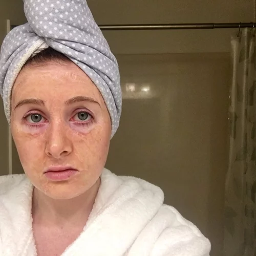 Hanacure: Η μάσκα προσώπου που σε μεταμορφώνει σε γιαγιά πριν σου χαρίσει τέλειο νεανικό δέρμα!