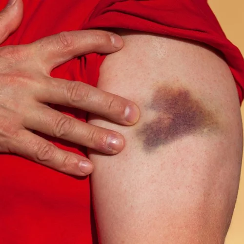 Γι' αυτούς τους λόγους μελανιάζεις με το παραμικρό