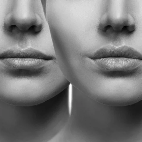 Όγκος στα χείλη και γέμισμα ρυτίδων χωρίς βελόνες | Η καινοτομία στις θεραπείες ομορφιάς