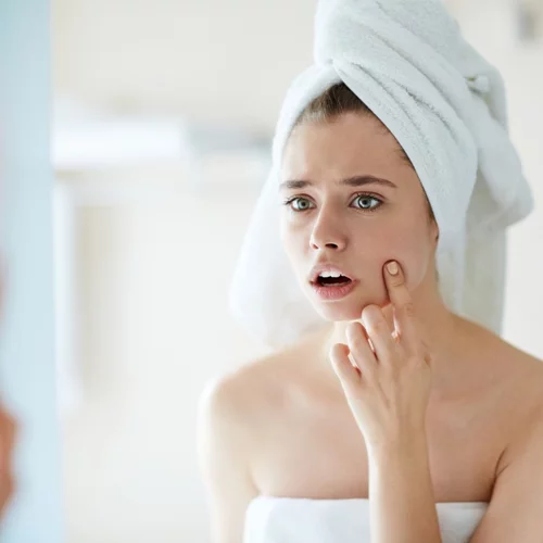 DIY τρόποι για να αντιμετωπίσεις την ξαφνική εμφάνιση ακμής