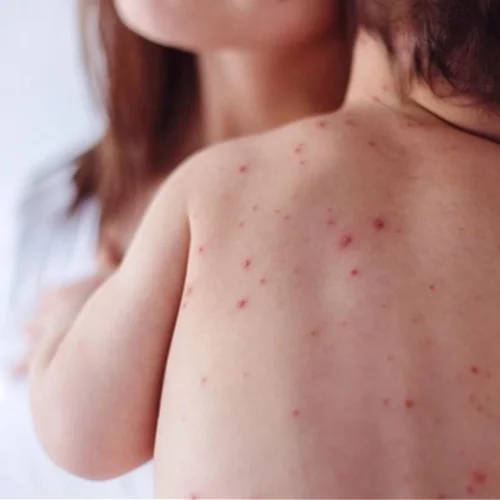 ΠΟΥ: Ανησυχία για την ιλαρά στην Ελλάδα