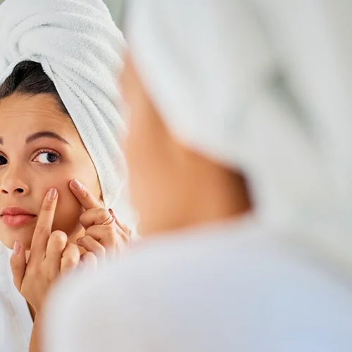 Πώς να σταματήσω να πειράζω τα σπυράκια; 5 εγγυημένοι τρόποι να δώσεις τέλος σε αυτήν την κακή συνήθεια!