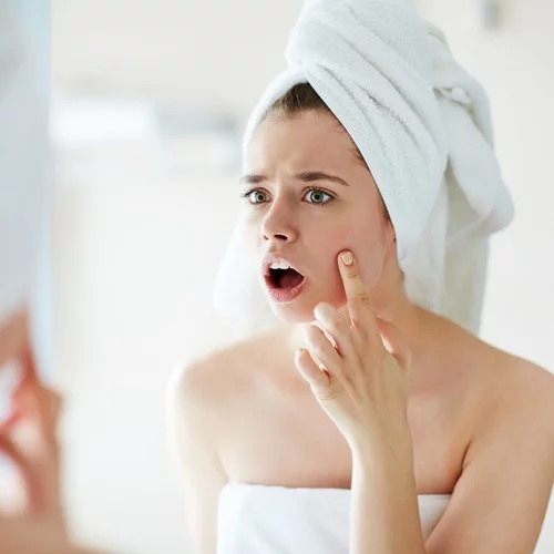 Ακμή; 5 tips για να ξεκινήσεις να την αντιμετωπίζεις από σήμερα κιόλας