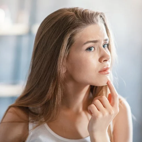 Ακμή στο πηγούνι | Σε τι οφείλεται και πώς μπορείς να την αντιμετωπίσεις