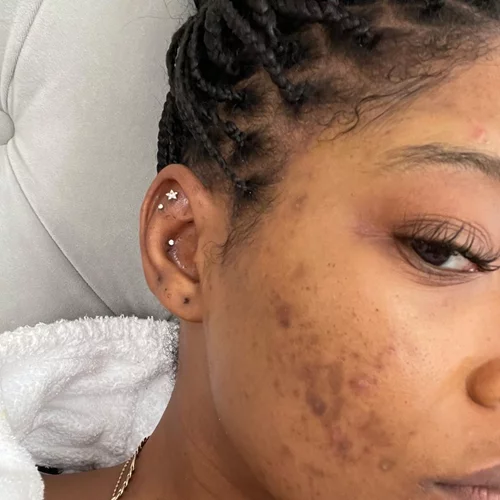 Πασίγνωστη star ποζάρει χωρίς makeup και αποκαλύπτει τη μάχη της με την ακμή