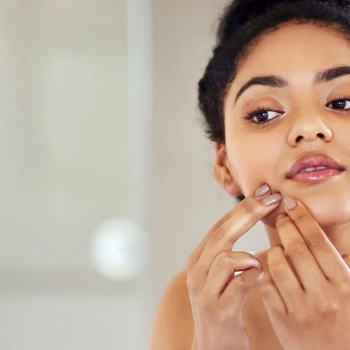 FYI Τα μικρά άσπρα σπυράκια στο πρόσωπό σου δεν είναι (ακριβώς) ακμή