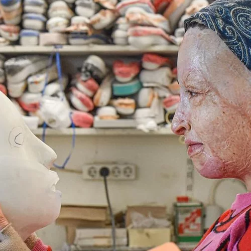 Ιωάννα Παλιοσπύρου | Το έγκαυμά της ίσως είναι το μεγαλύτερο παγκοσμίως, λέει η γιατρός της