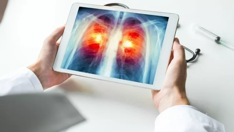 καρκινος του πνευμονα