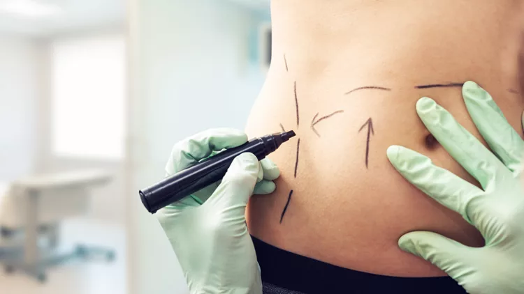 plastic surgeon marking womans body for surgery