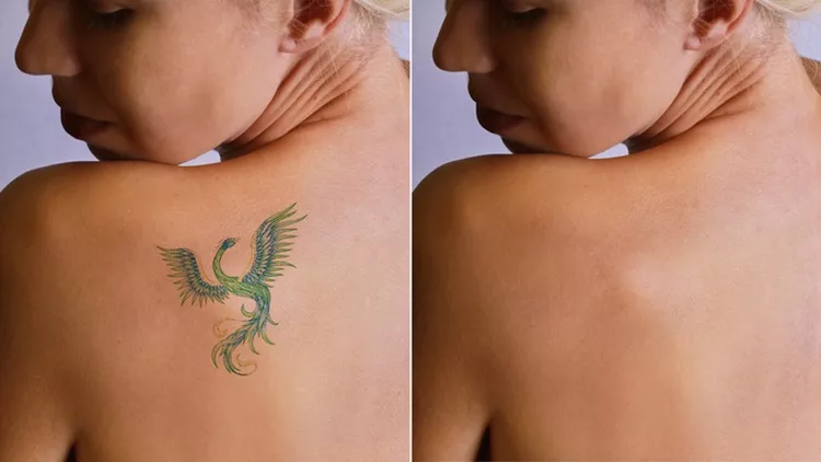 Laser tattoo removal befor and after.