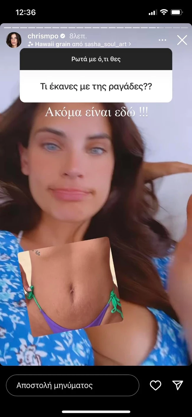 ραγάδες εγκυμοσύνης