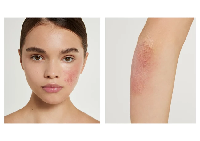 ξηρό με τάση ατοπίας