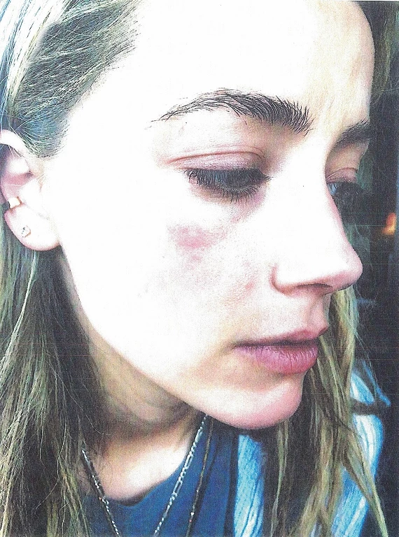 Bruising on Amber Heard's face she claims was inflicted by Johnny Depp. The photo exhibits were presented to Los Angeles Superior Court as Amber filed a restraining order against her estranged husband. The actress claims Depp attacked her at their downtown Los Angeles apartment on May 21, 2016. She filed for divorce two days later. Pictured: Amber Heard Ref: SPL1292262 270516 Picture by: Splash News Splash News and Pictures Los Angeles:310-821-2666 New York: 212-619-2666 London: 870-934-2666 photodesk@splashnews.com 