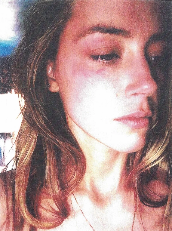 Bruising on Amber Heard's face she claims was inflicted by Johnny Depp. The photo exhibits were presented to Los Angeles Superior Court as Amber filed a restraining order against her estranged husband. The actress claims Depp attacked her at their downtown Los Angeles apartment on May 21, 2016. She filed for divorce two days later. Pictured: Amber Heard Ref: SPL1292262 270516 Picture by: Splash News Splash News and Pictures Los Angeles:310-821-2666 New York: 212-619-2666 London: 870-934-2666 photodesk@splashnews.com 