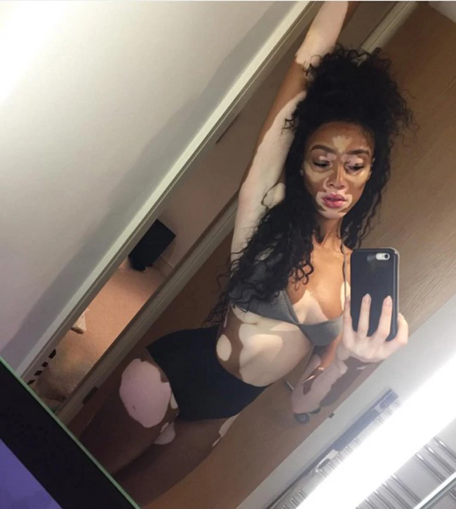 Winnie Harlow: Το μοντέλο που πάσχει από λεύκη γίνεται viral μέσα από μία συγκινητική ανάρτηση