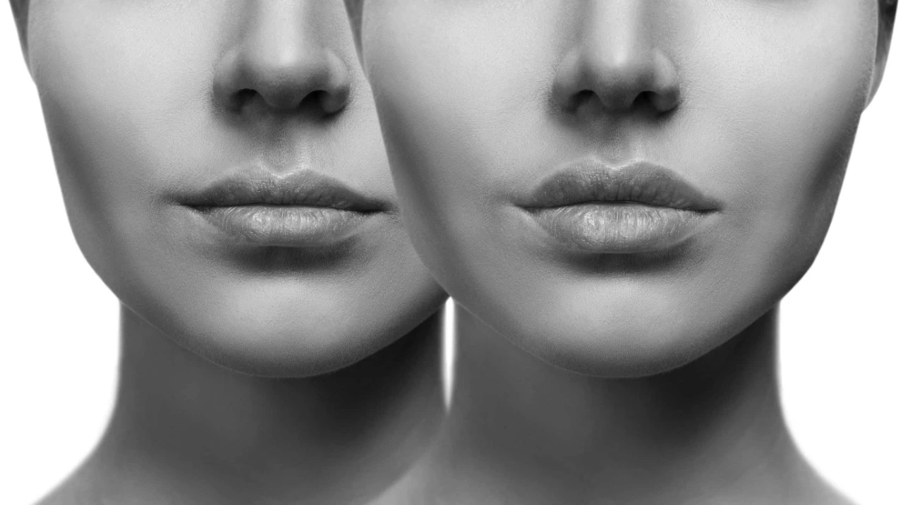Όγκος στα χείλη και γέμισμα ρυτίδων χωρίς βελόνες | Η καινοτομία στις θεραπείες ομορφιάς