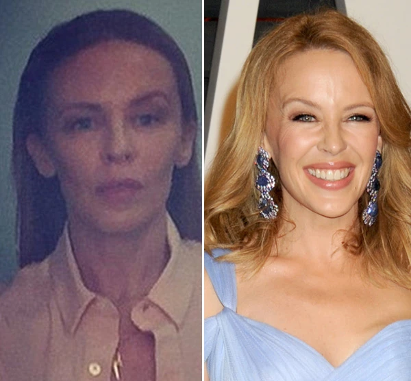 Kylie Minogue: Έπαθε Uma Thurman; Τι συνέβη στο πρόσωπό της; - εικόνα 2